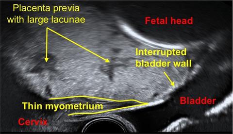 placenta accreta ultrasound