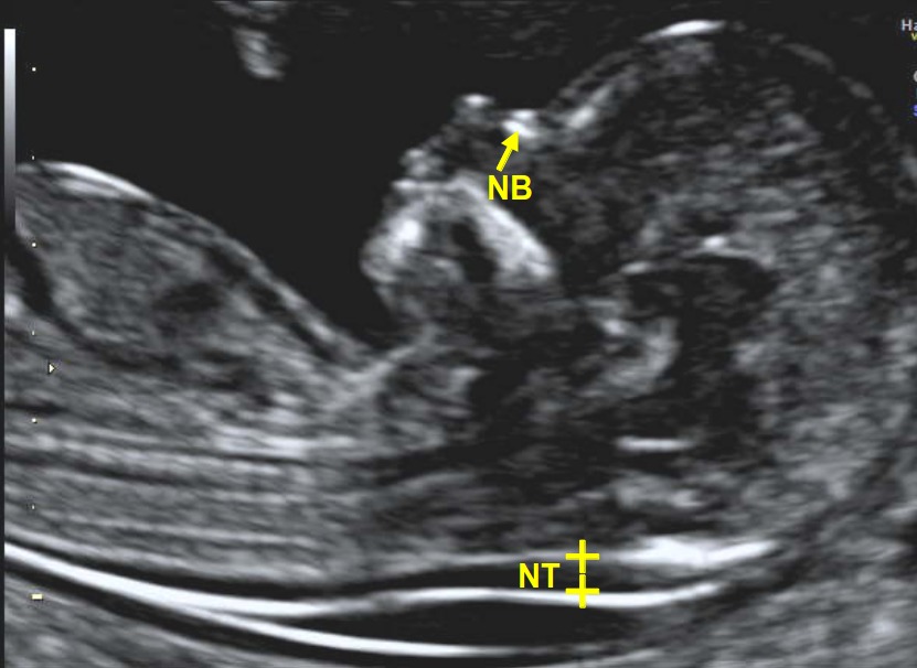 Increased Nuchal Translucency Ultrasound In