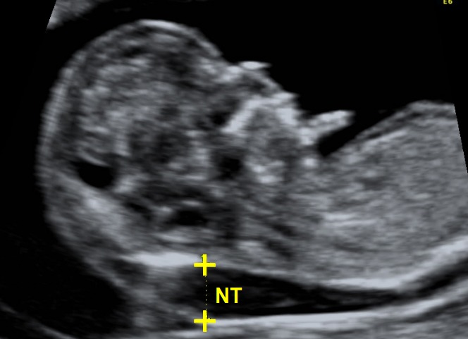 Translucency screening is nuchal what Normal Values