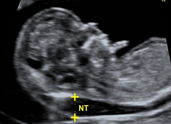 A what scan is nuchal Nuchal Translucency