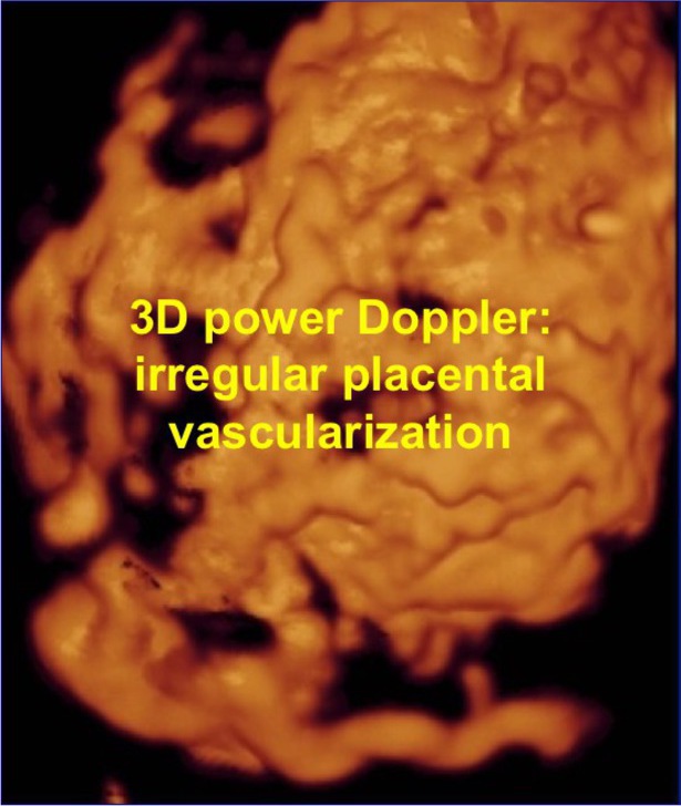 Morbid adherent placenta