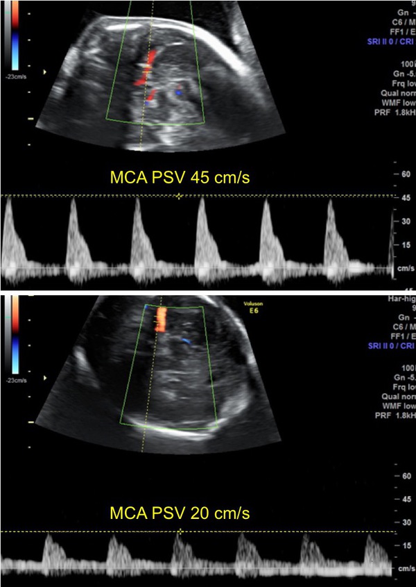 MC twins: twin anemia-polycythemia sequence